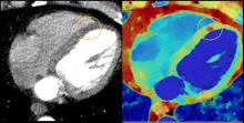 Illustration of how spectral CT can help confirm findings on a conventional CT scan without requiring follow-up imaging, such as a nuclear scan. The conventional CT on the left, and the dual-energy CT on the right confirms an infarct.