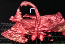 echopixel, DAIC, TEE, mitraclip, replacement for angiography, structural heart