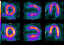 Myocardial perfusion, cardiac perfusion imaging, nuclear cardiology, molecular cardiology