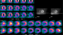 Technetium-99m is primarily used for the detection of cancer and to assess perfusion defects in the heart caused by heart attacks or other conditions.