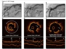 Angiography shows a stenotic lesion in the mid right coronary artery, undilatable by standard high-pressure balloon angioplasty (inset, arrowheads). (B) Optical coherence tomography (OCT) cross-sectional (top) and longitudinal (bottom) images acquired before IVL and coregistered to the OCT lens (arrow in A) demonstrate severe near-circumferential calcification in the area of the stenosis. (C) Angiography demonstrates improvement in the area of stenosis after IVL lithoplasty.