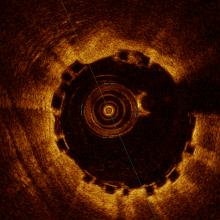 SJM, OCT, Optical coherence tomography, Bioresorbable stent, BVS