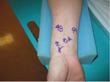 The use of the Barbeau test in radial access procedures.