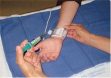 radial access, transradial