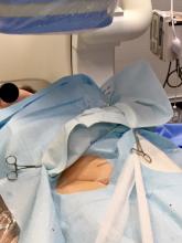 Radial access, transradial access, radial artery access, drapes, drape can help speed procedure times.