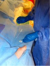 radial access, transradial