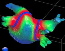 A CyberHeart cardiac ablation radiotherapy treatment plan showing where the radiation beam will ablate for a noninvasive pulmonary vein isolation procedure. Varian acquires, buys, purchases Cyberheart.