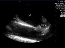 An example of intra-cardiac echo (ICE) imaging showing two of the pulmonary veins, anatomical landmarked used during ablation procedures to treat atrial fibrillation. This example is from the ICE system used by St. Jude Medical. 