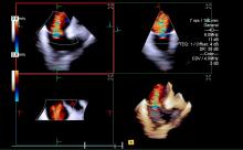 An example of intra-cardiac echo (ICE) imaging from Siemens Healthineers showing color flow Doppler with severe valve regurgitation. ICE has seen wider use in transcatheter structural heart  procedures because, unlike TEE, it can be used without deeper sedation of anesthesia.