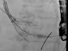 An angiographic view of a Medtronic Corevalve being deployed. Fluoroscopy does not show soft tissue, so CT overlays showing anatomical landmarks and TEE are used for procedural guidance. 
