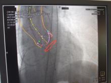 The Siemens syngo Aortic ValveGuide software, similar to other TAVI systems, offers a circle at the base of the valve to indicate when the aortic root is in plain on angiographic imaging. When the circle disappears into a single straight line, the valve is in plain.
