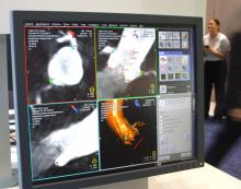 Siemens' syngo Aortic ValveGuide software enables TAVR procedural planning and delivery guidance.