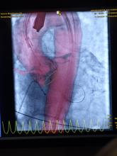 The GE Healthcare ValveAssist software enables trans-aortic valve replacement (TAVR) procedural planning and guidance with integration on live fluoro imaging.