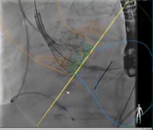 CMS Finalizes Updates to Coverage Policy for Transcatheter Aortic Valve Replacement
