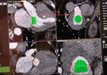 An example of an evaluation for the neo-left ventricular outflow tract (neo-LVOT) on CT imaging for a transcatheter mitral valve replacement using Circle Imaging's advanced visualization software. TMVR assessment at #SCCT19
