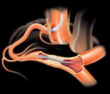 Terumo's FineCross guidewire to navigate CTOs.