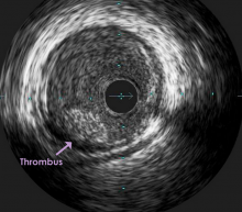 acute ischemic stroke, larger thrombi retrieval, improved neurological recovery, ESC 2015, MR CLEAN trial, sub-study