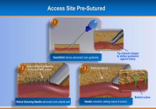 TAVR, EVAR Vascular Closure Device May Eliminate Need for Surgical Cut-Down