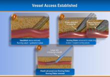 TAVR, EVAR Vascular Closure Device May Eliminate Need for Surgical Cut-Down