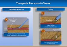 TAVR, EVAR Vascular Closure Device May Eliminate Need for Surgical Cut-Down