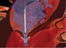 The Abbott Mitraclip device for transcatheter treatment of mitral valve regurgitation. Cross sectional view of implantion
