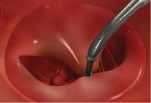 The Abbott Mitraclip device for transcatheter treatment of mitral valve regurgitation.