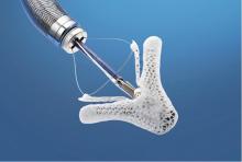 The Abbott Mitraclip device for transcatheter treatment of mitral valve regurgitation.