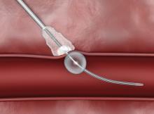 The bioresorbable Cordis Mynx Grip vascular closure device seals arteriotomies without use of permanent hardware.
