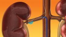 MEDTRONIC, symplicity renal denervation catheter