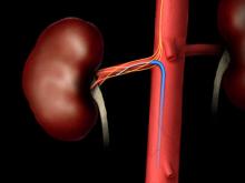 An example of renal denervation therapy being delivered. A catheter is inserted into the renal artery to ablate the nerves in the vessel wall that regulate vasoconstriction. This leaves the vessel permanently in the widest open position to allow greater blood flow to the kidneys.