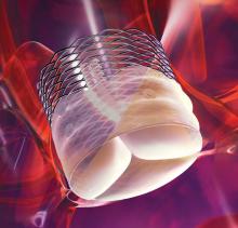 The Boston Scientific Lotus TAVR Valve