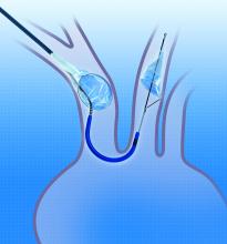 Claret embolic protection, TAVR, cerebral protection