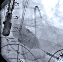 Sapien, TAVR, hybrid OR