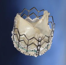 Edwards Sapien Valve Partner Clinical Trial Heart Valve Repair