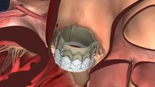 Edwards Sapien TAVR valve