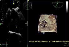 Philips introduced CX50 xMatrix architecture designed to support advanced fluoro integration with the EchoNavigator system. It aligns TEE views with live fluoroscopy to enhance navigation in complex structural heart procedures. Transesophageal echo (TEE).