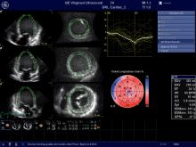 GE Healthcare's cardiac ultrasound strain assessment software helps quantify left ventricular wall motion to determine if there is damage to cardiac function due to cancer therapy. GE Ultrasound, GE echo, strain, cardio-oncology