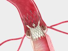 Corevalve, FDA, Edwards, TAVR, TAVI, lawsuit, injunction