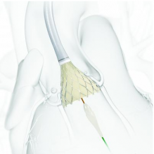 Medtronic's CoreValve Evolut R gained FDA approval for intermediate risk patients