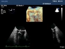 Philips' live 3-D TEE view of a mitral valve balloon valvuloplasty. Transesophageal echo