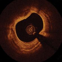 St. Jude Medical, OCT, ILUMIEN III, IVUS, angiography, PCI
