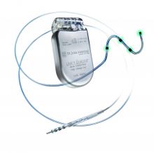 ICD, implantable cardioverter defibrillator, quadripolar leads