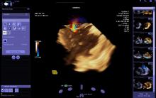 Siemen's AcuNav V intra-cardiac echo catheter.