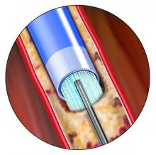 Spectranetics Peripheral Artery Disease Laser Atherectomy 