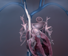 Spectranetics Bridge Occlusion Balloon in the SVC