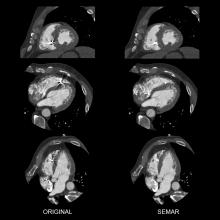 Toshiba's metal artifact reduction software for the Aquillion One CT scanner