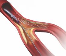 Tryton Side Branch Stent TRYTON Pivotal FDA IDE trial 