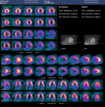 Ultraspect dose lowering software for nuclear imaging, SPECT imaging, reconstructions.