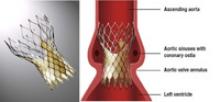 CoreValve prosthesis