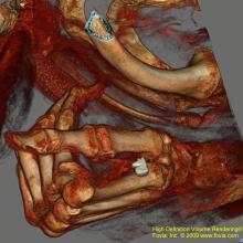3-D reconstruction from a CT scan a mummy's hand.